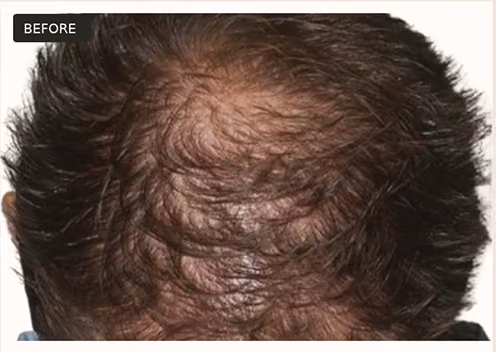 Top of a person's head showing thinning hair and significant hair loss around the crown area, labeled 'BEFORE'.