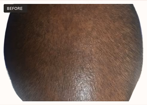 Close-up view of the top of a person's head with thinning hair, showing sparse hair coverage and visible scalp, labeled 'Before'.