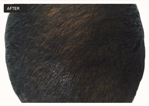 Top view of a person's scalp labeled 'AFTER' showing dark hair that appears thicker and fuller.