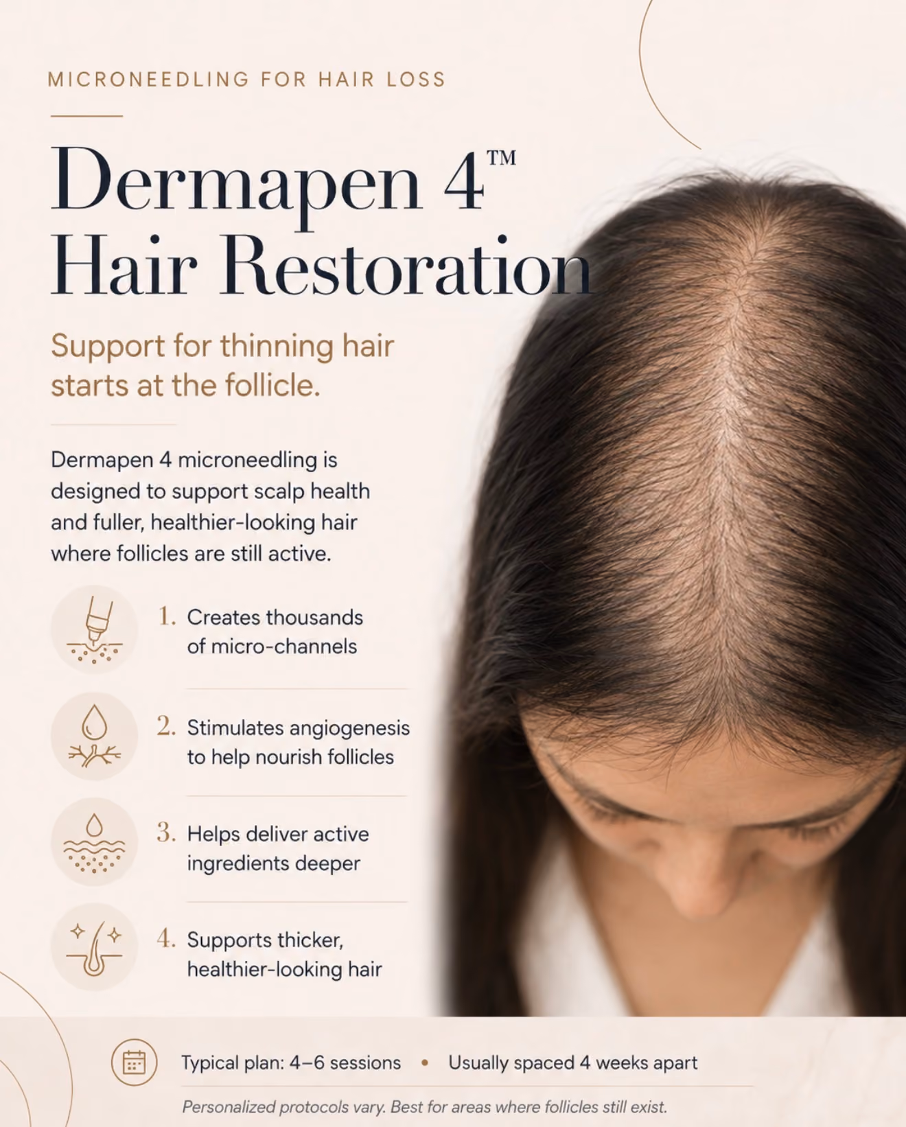 Infographic about Dermapen 4 Hair Restoration microneedling for thinning hair showing top view of a woman with thinning hair on her scalp. Text lists benefits: creates thousands of micro-channels, stimulates angiogenesis to nourish follicles, helps deliver active ingredients deeper, supports thicker, healthier hair. Typical plan: 4-6 sessions usually spaced 4 weeks apart.