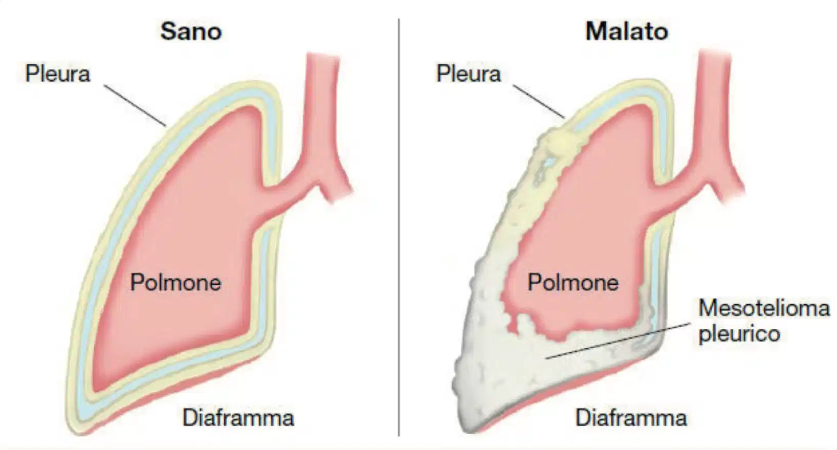 Schema comparativo tra pleura sana e pleura interessata da mesotelioma pleurico.