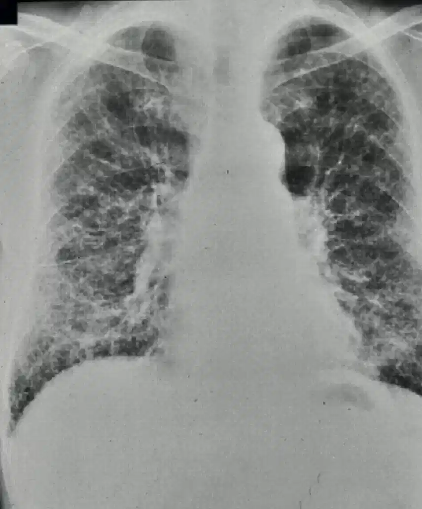 Radiografia toracica con diffuse alterazioni polmonari compatibili con fibrosi da esposizione ad amianto