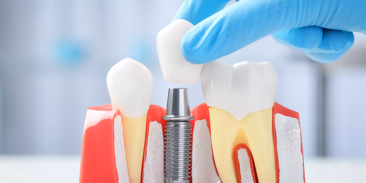 Clinical evaluation of dental implant systems in China - New guidelines issued