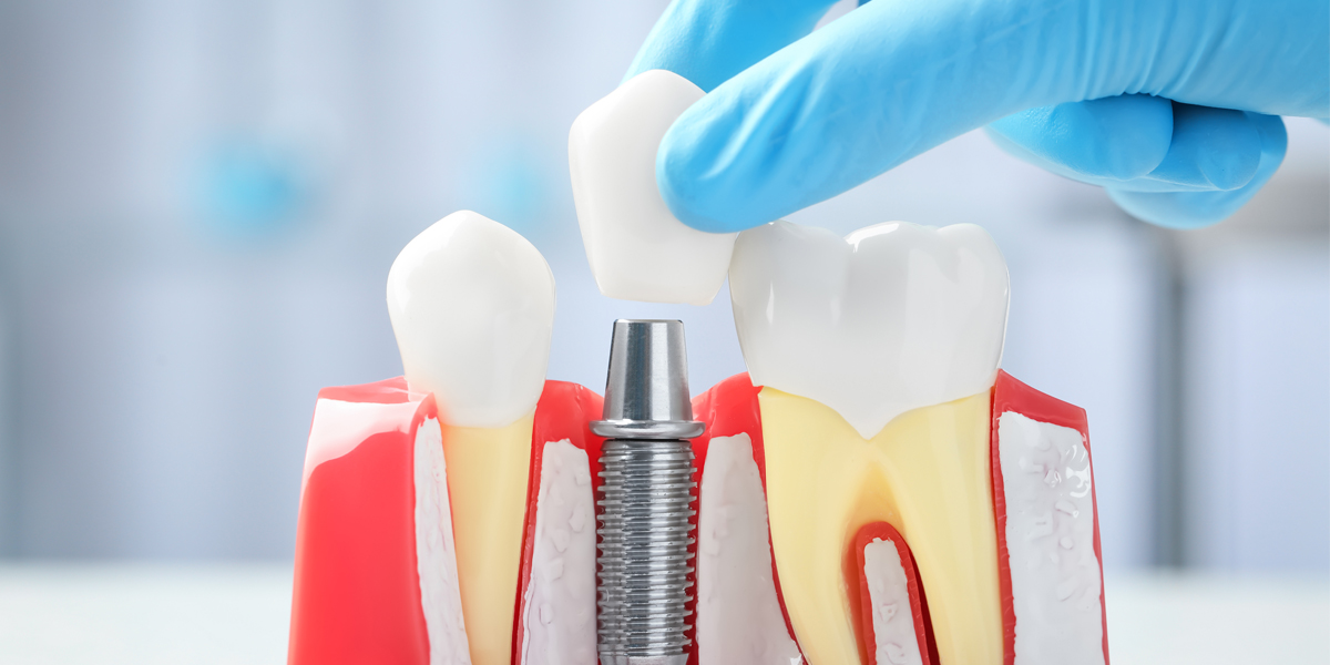 Clinical evaluation of dental implant systems in China - New guidelines issued