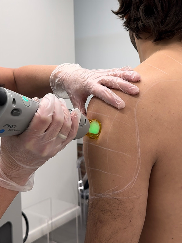 Laser hair removal procedure on shoulder.