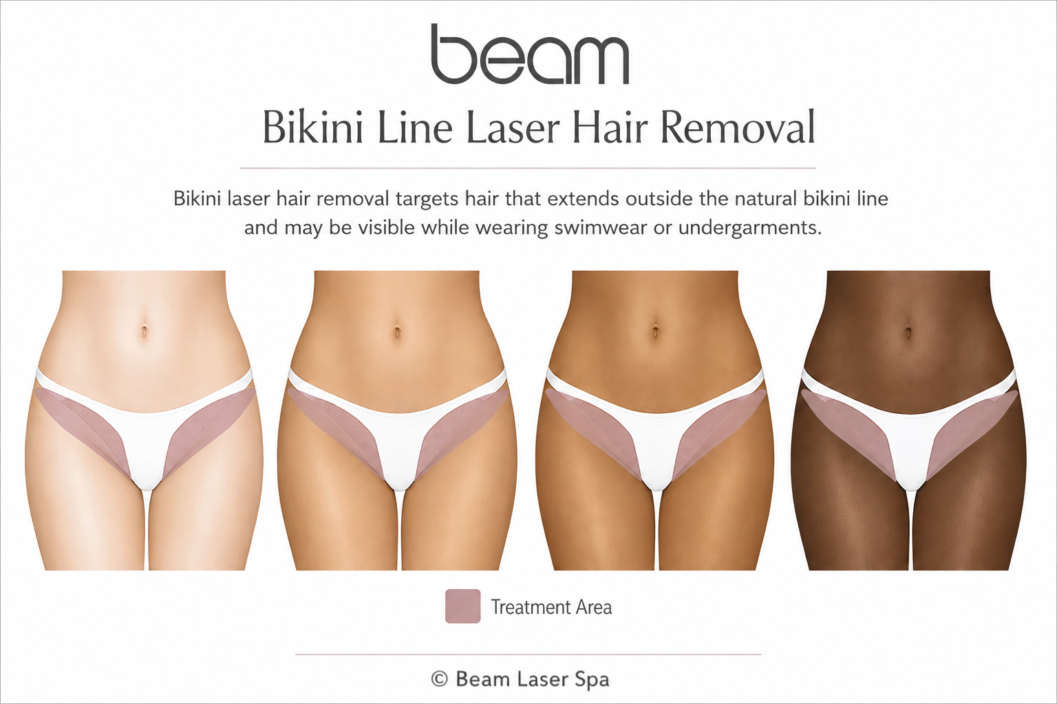 Bikini Line Laser Hair Removal