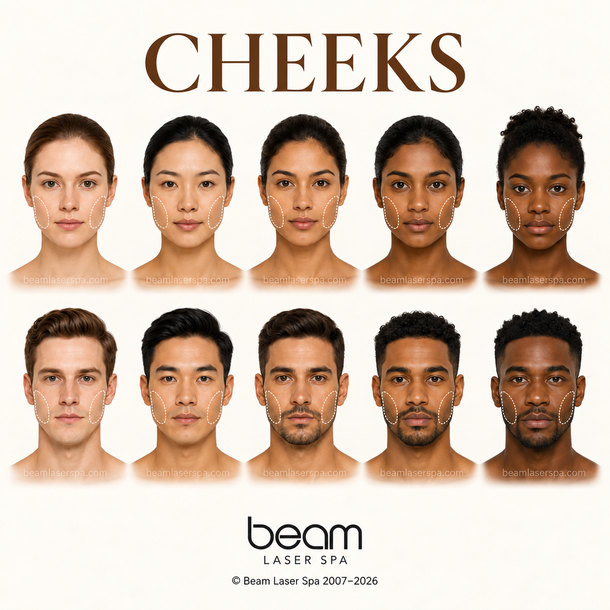 Cheeks Laser Hair Removal