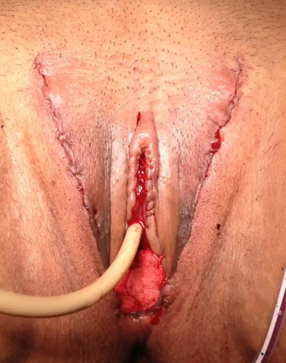 The catheter (yellow) is in the urethra and drains the bladder. The vaginal packing is in place. The drain is visible in the lower right corner of the picture.
