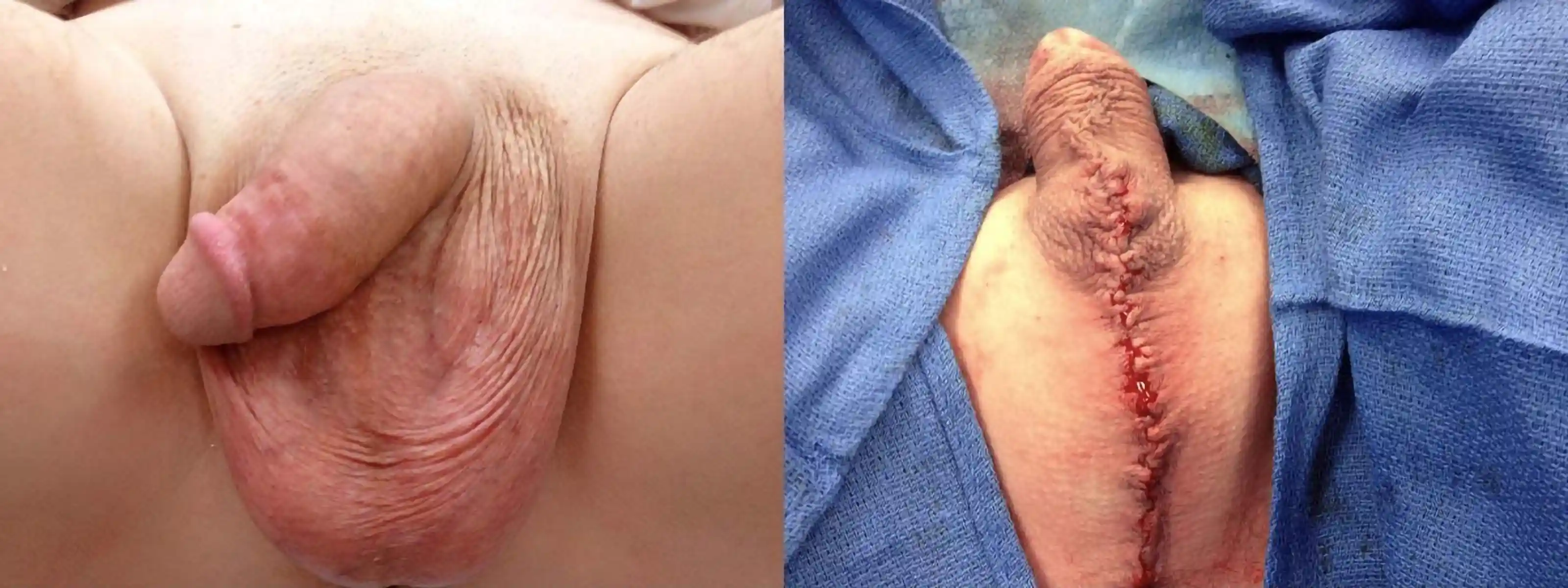 Orchiectomy with scrotal reduction for a patient with no intention of future vaginoplasty. This approach allows for possible continued erection and recreates the midline raphe.