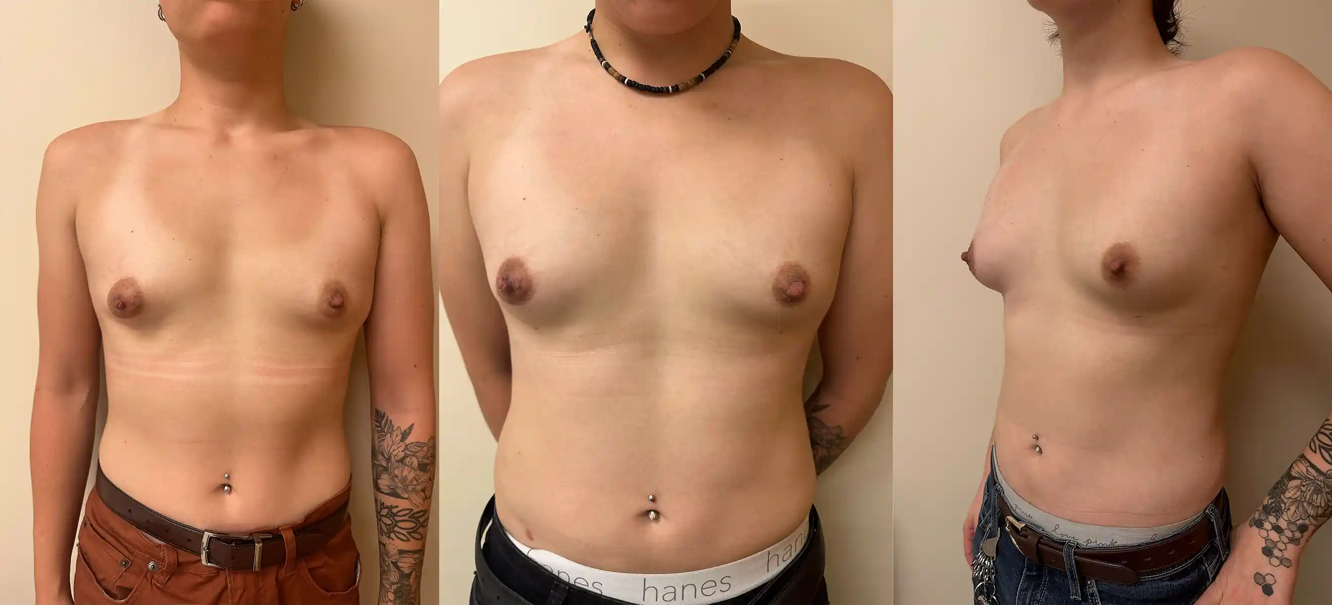 This patient, active in rugby, chose fat grafting instead of implants. Shown are results after two rounds of breast fat grafting. The first round focused on shape and balance, while the second added volume. Liposuction of the abdomen, flanks, and thighs was also performed.