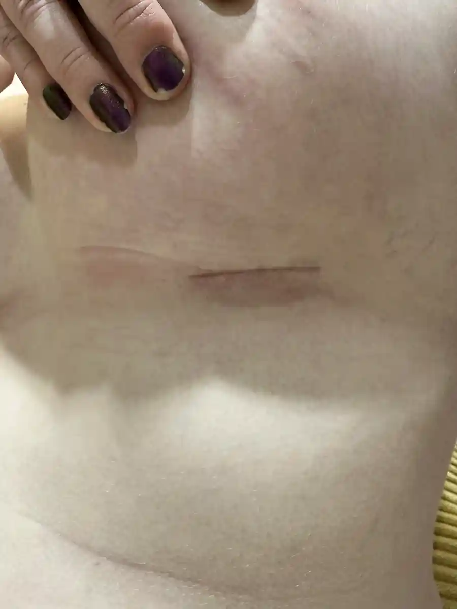 Example of breast incision at one month after silicone implant placement. The scar will soften and fade to a fine white line over the next few months.