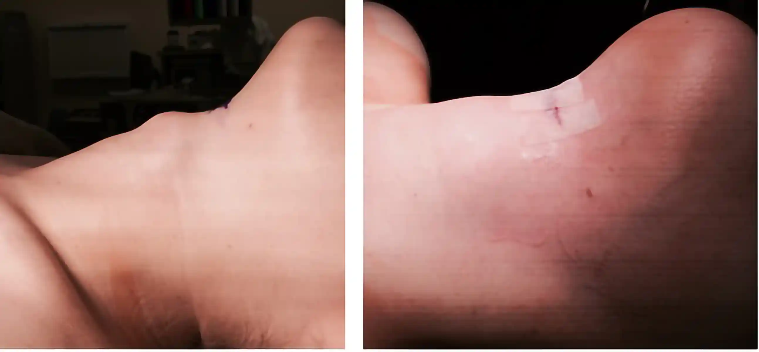 Before-and-after on the table, showing significant improvement in contour and scar placement.