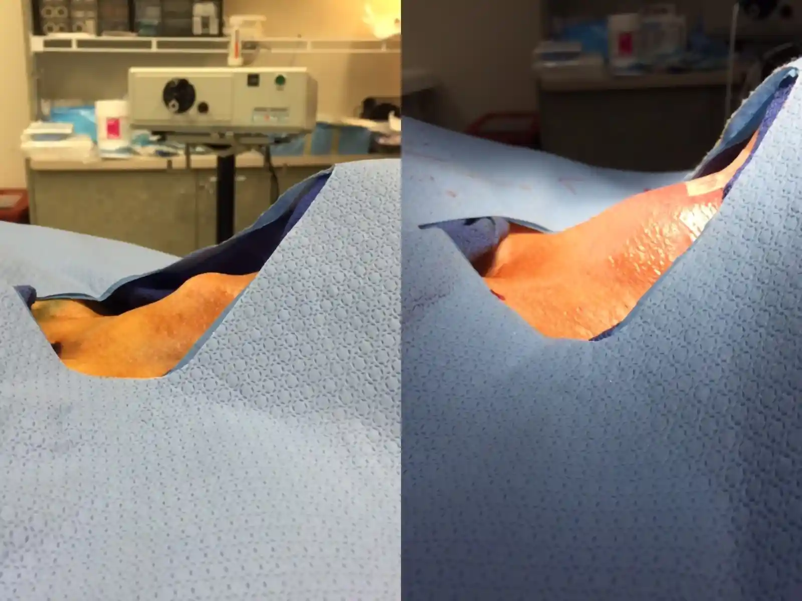 Before and after views showing the dramatic change in neck contour achieved in this short procedure.