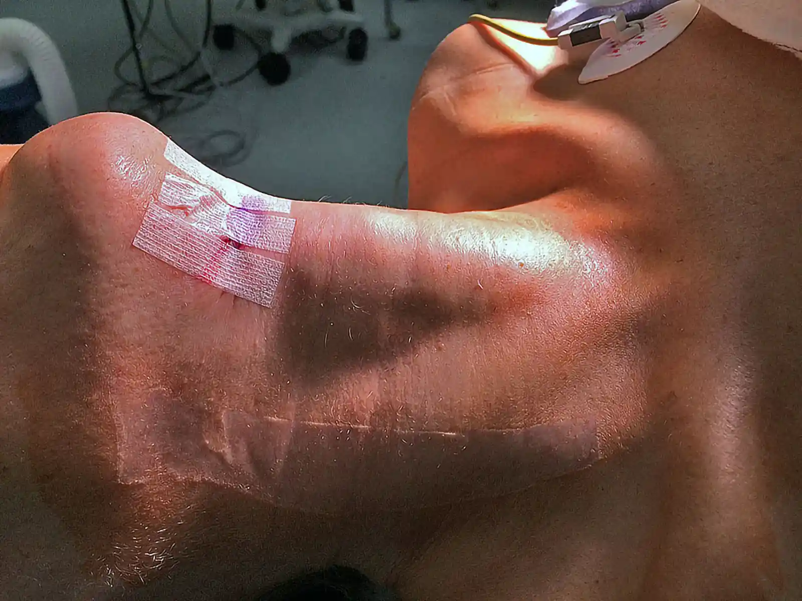 The cartilage in the neck supports vocal structures. Care is always taken to protect these areas during this open approach.