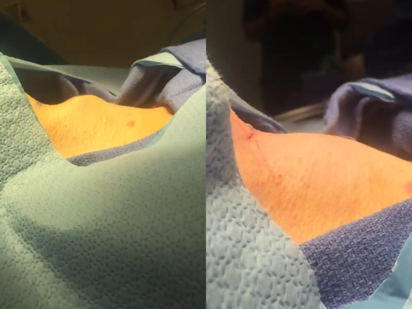 This was a more ossified or bony trachea. With age, tracheal cartilage turns to bone. Despite this, the contour can still be reduced effectively.