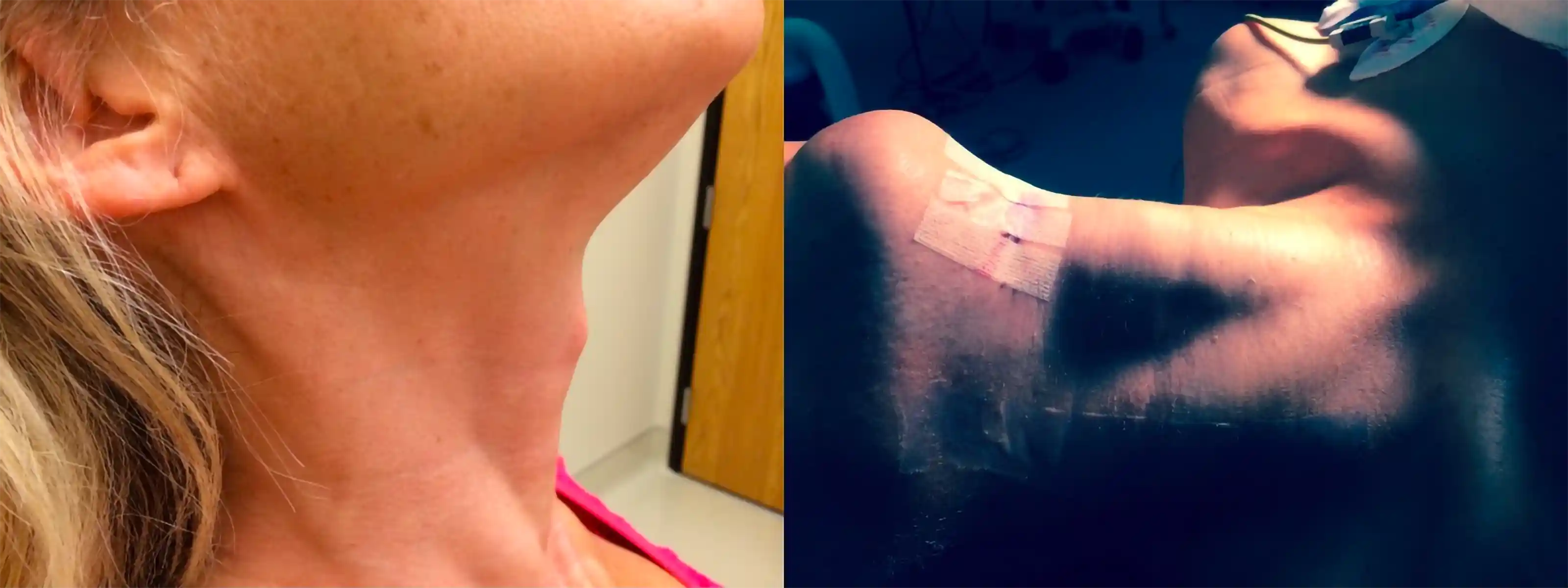 This patient had a small tracheal prominence that caused significant gender dysphoria. Removal provided more confidence and satisfaction.