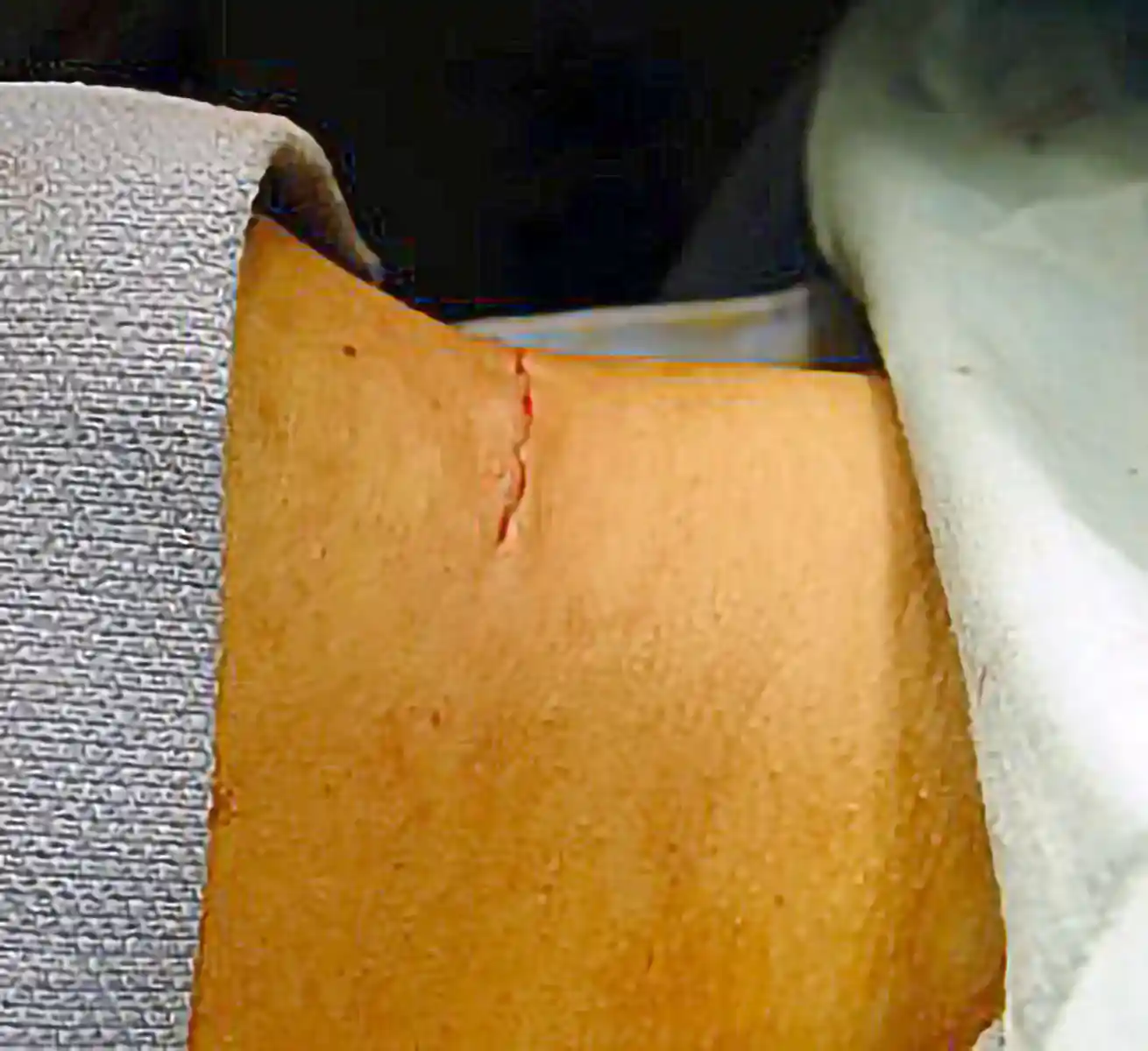 Demonstrates the flat neck contour that we aim to achieve with tracheal shave surgery.