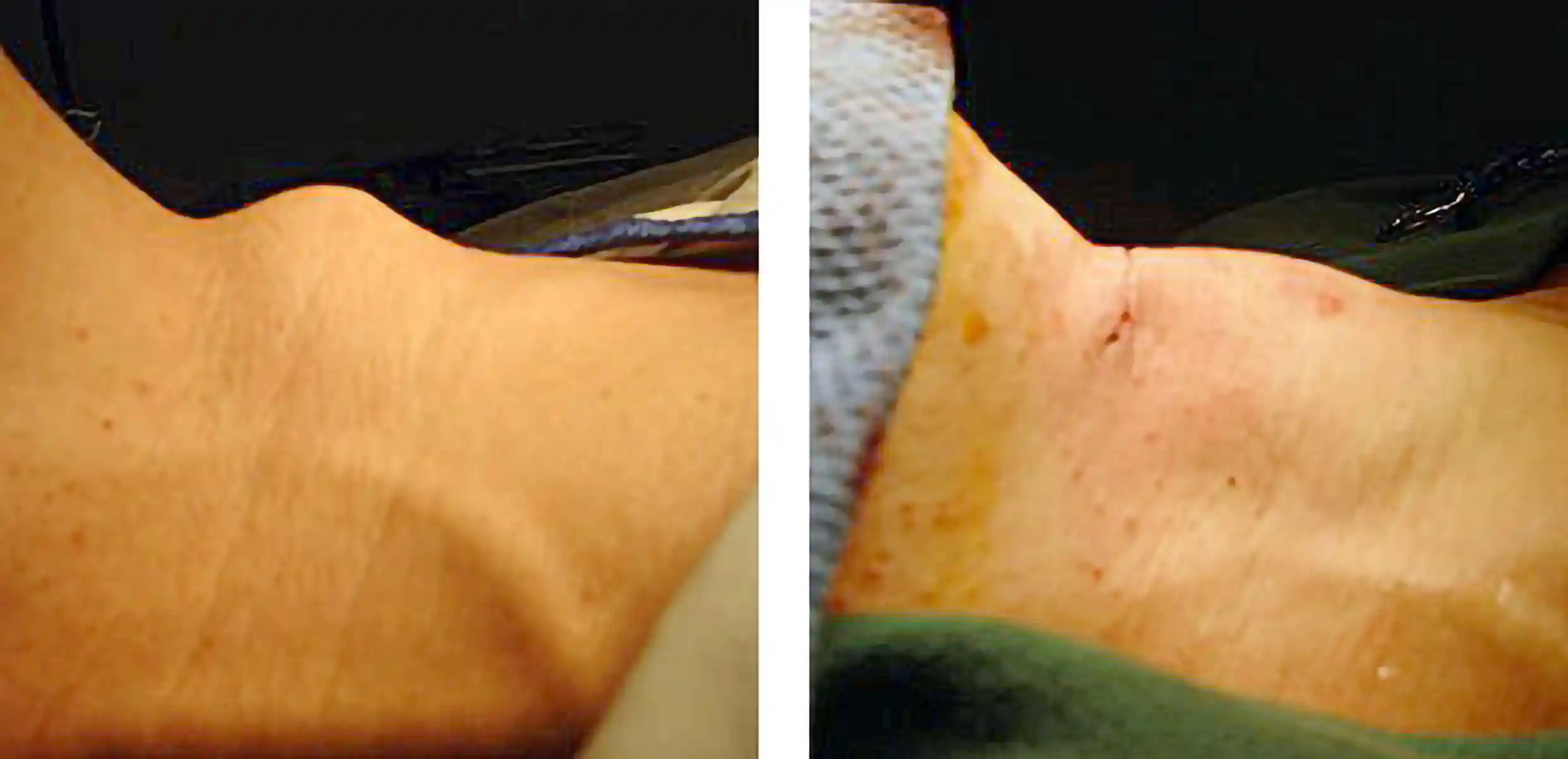 This patient was self-conscious of her prominent tracheal cartilage. In a 30-minute operation, this contour was greatly improved.