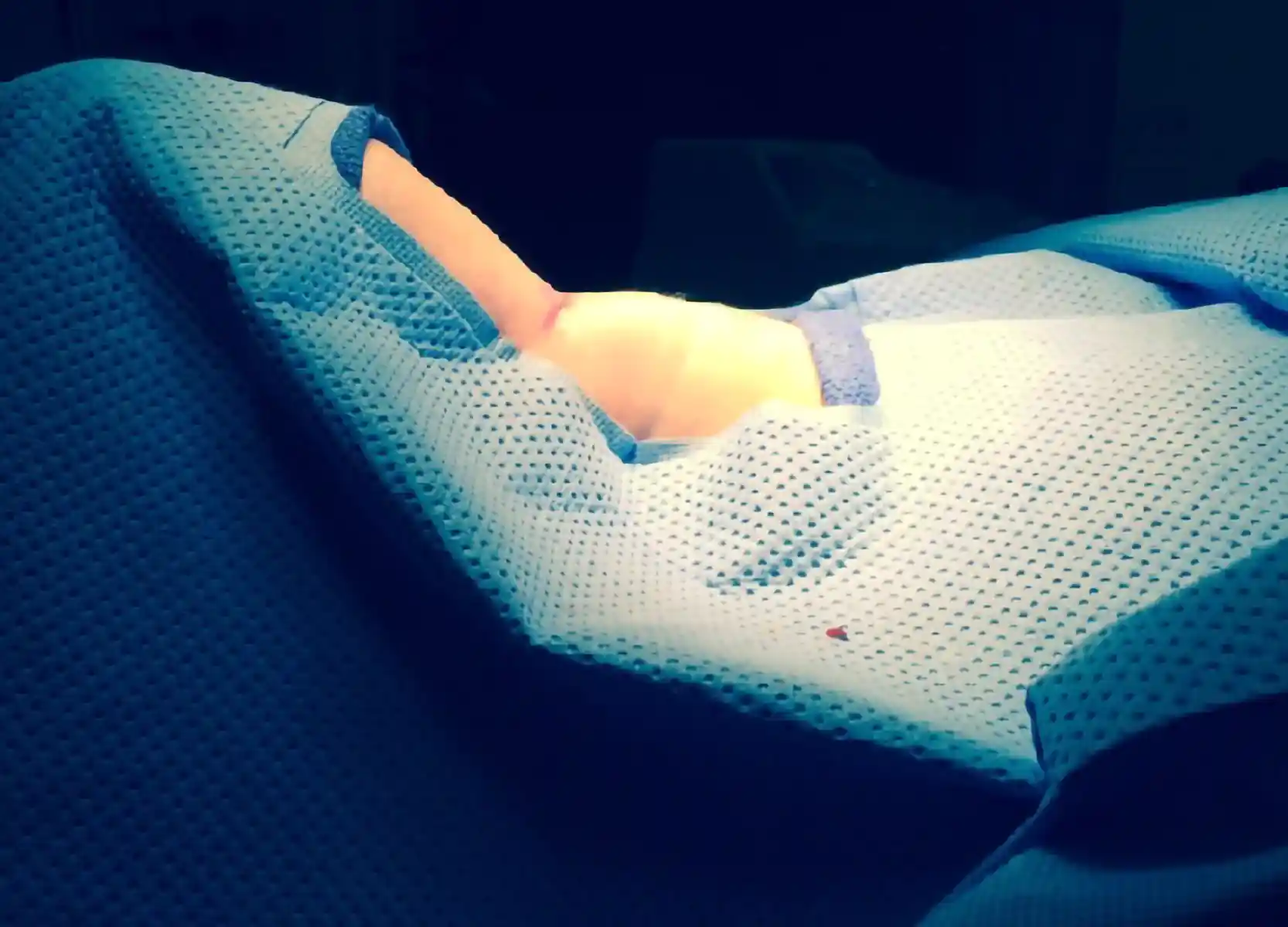 Shows scar placement for the tracheal shave. The incision is hidden in a natural neck crease, away from the tracheal cartilage, making the scar less visible.