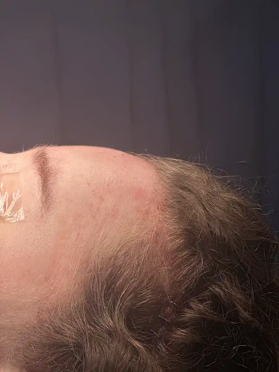Example of the ideal forehead shape achieved during surgery. Incisions placed behind the hairline become virtually invisible.
