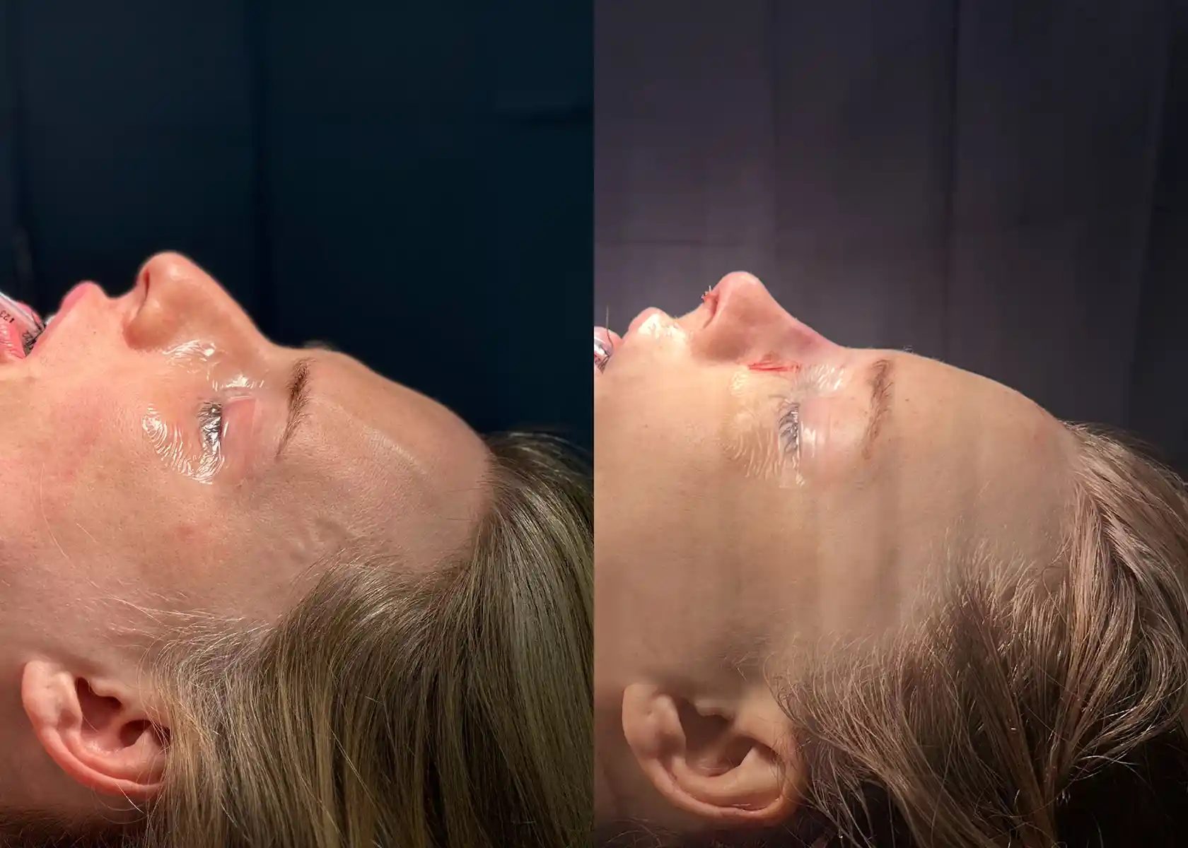 Forehead softening with frontal sinus reduction and rhinoplasty refinement. The incision was hidden behind the hairline for minimal visibility.