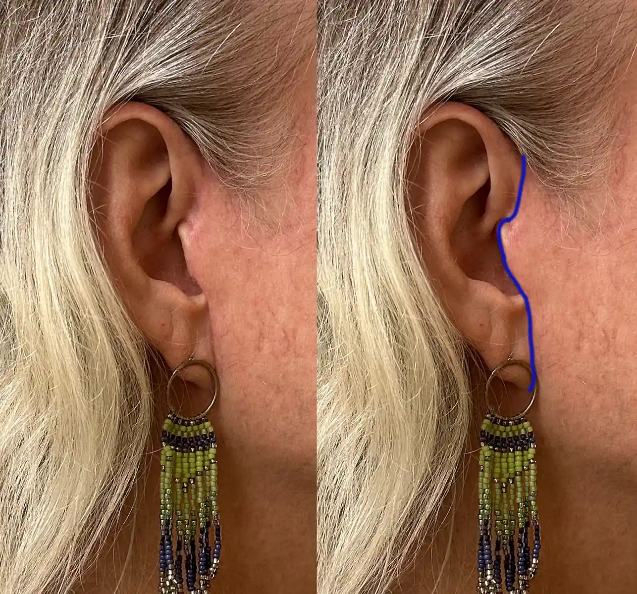 Example of face and neck lift scars. Scars are virtually invisible due to meticulous closure and use of absorbable sutures—no removal required.