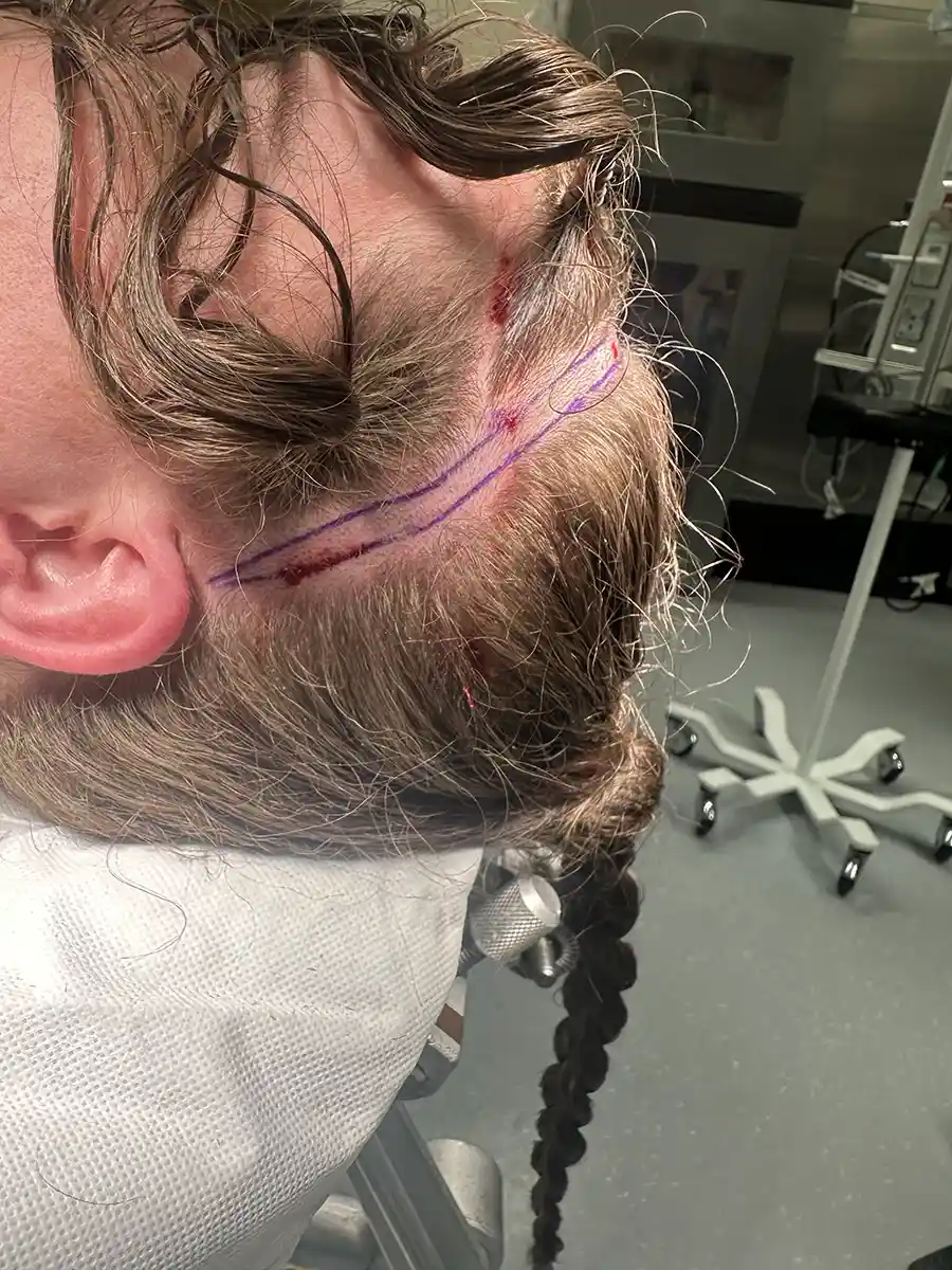 Example of incision line when the forehead is not reduced. A small area of hair is shaved and removed for a brow lift. The scar is hidden in the hair and nearly invisible.