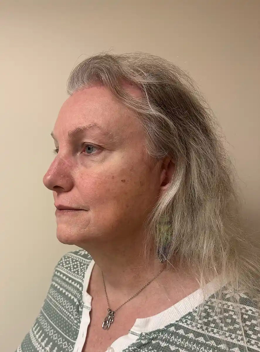 Full sinus reduction, hairline shortening, orbital remodeling, brow lift, jaw contouring, and facelift. This procedure rejuvenated the face by roughly 10 years while enhancing feminization.