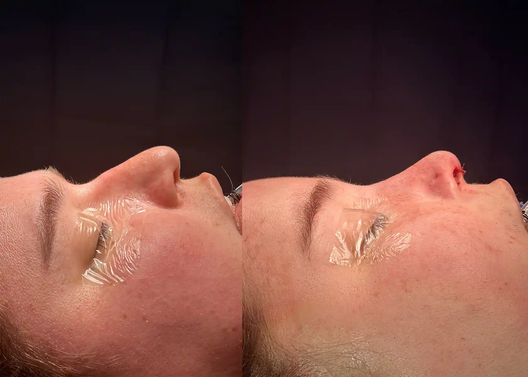 Frontal sinus reduction flattened the forehead-to-nose curve. A minor dorsal hump reduction and gentle nasal tip lift were performed to preserve natural appearance.