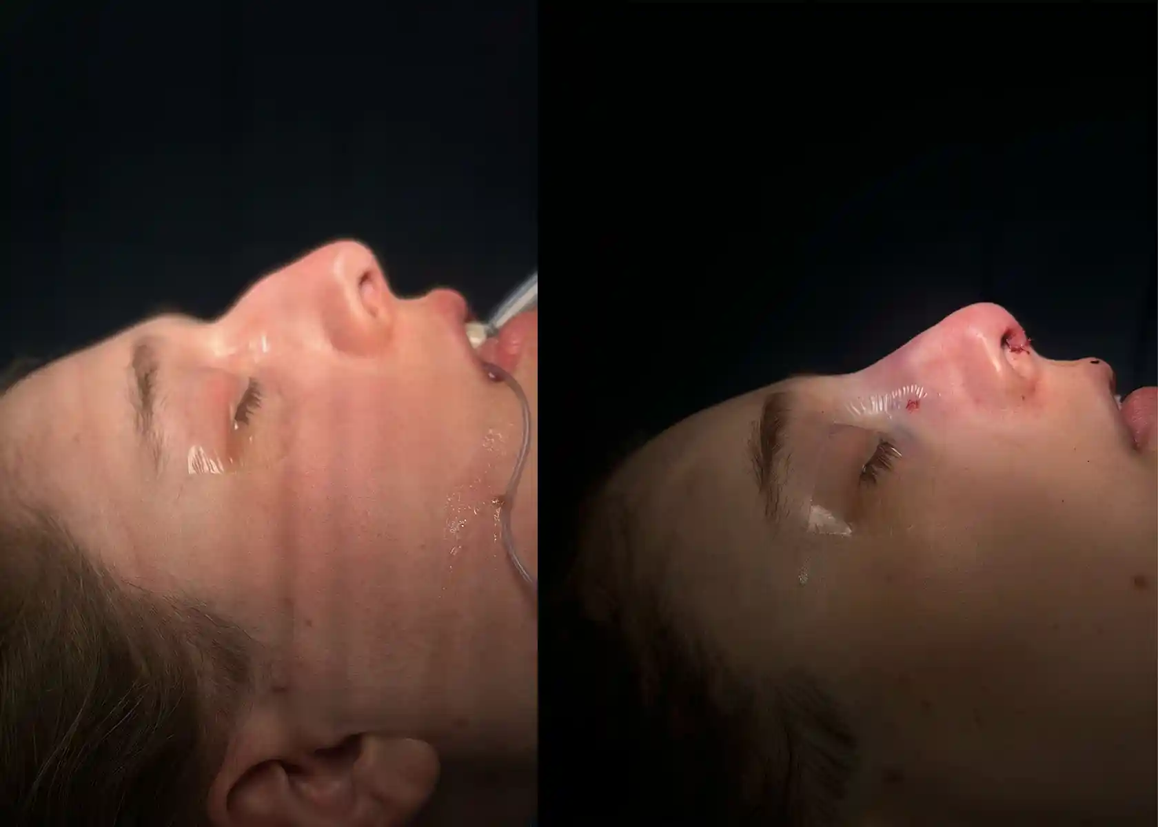 Shows how gentle reductions of the frontal sinus and orbits, along with rhinoplasty, create softer proportions and natural facial balance.