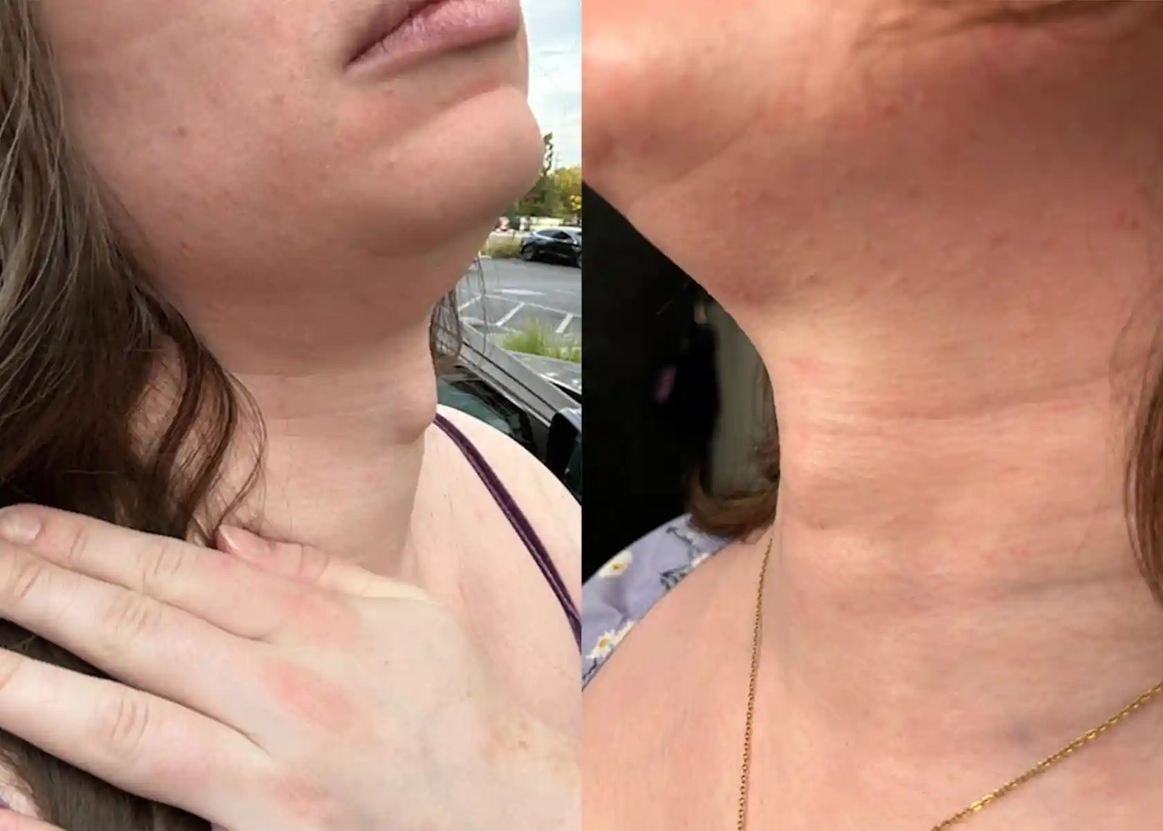 Before and months after tracheal shave. The Adam’s Apple was significantly reduced, leaving a nearly invisible small scar after healing.
