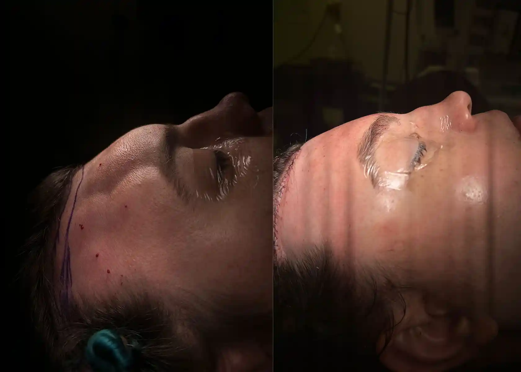 This patient had a full setback of the frontal sinus (over 1 cm). Lateral orbital bones were reduced to open the eyes, and a gentle brow lift enhanced expression. The hairline was advanced about 2 cm. The nose was revised later by another surgeon.