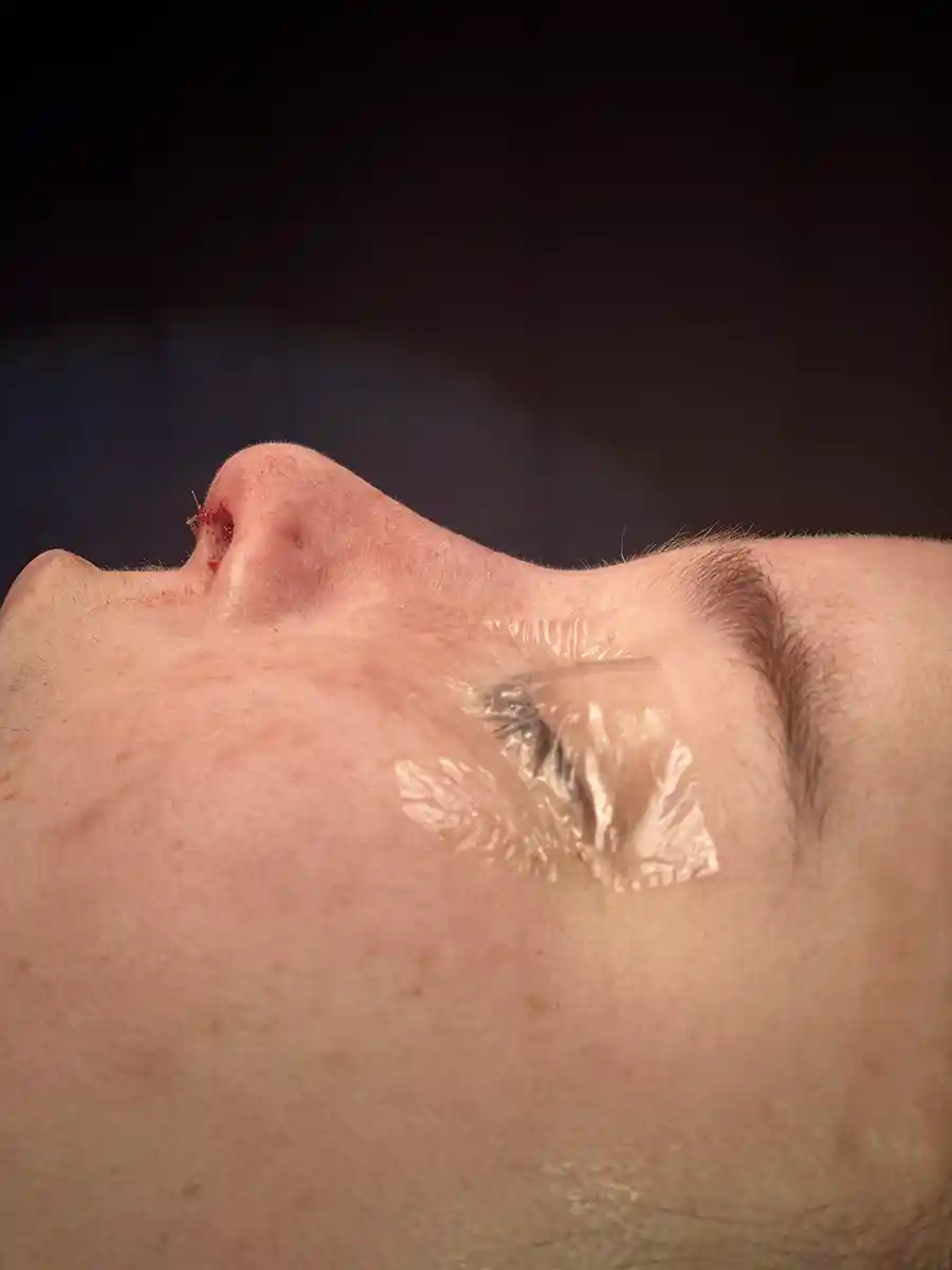 Illustrates balance between the forehead and nose to create harmony and facial unity.