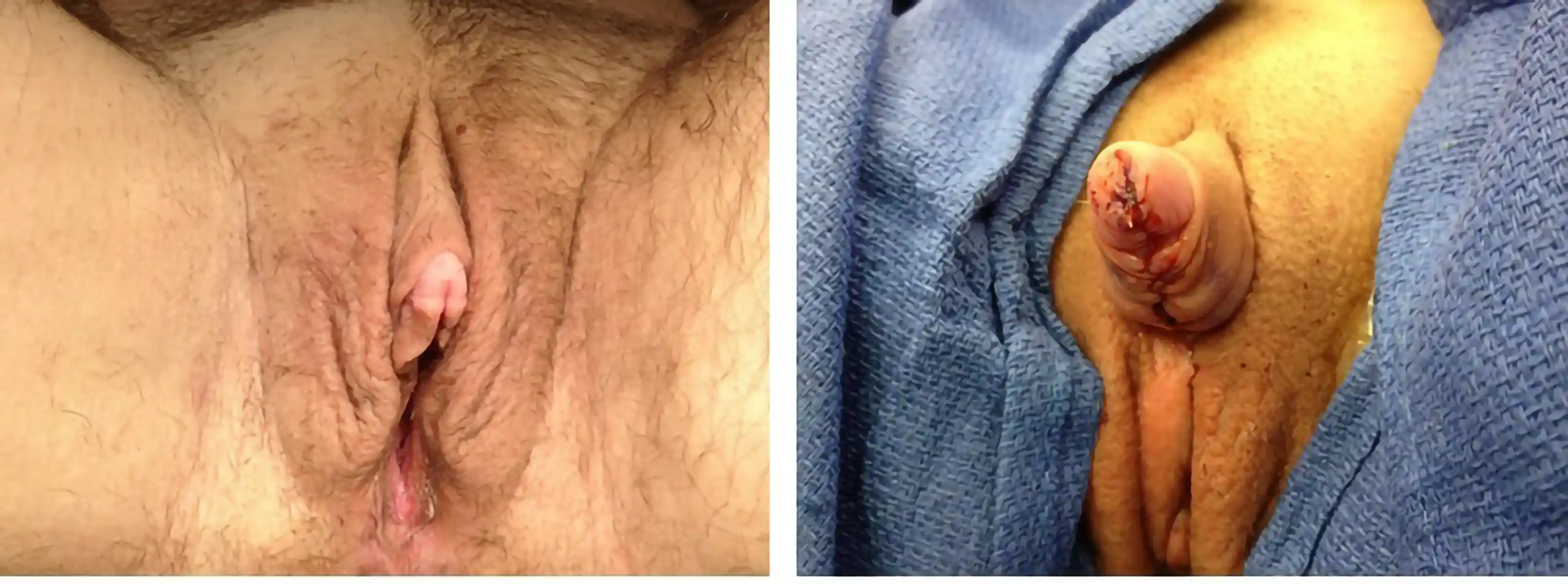 Before and after metoidioplasty. This patient had significant penile growth on testosterone, enhanced by the surgery.