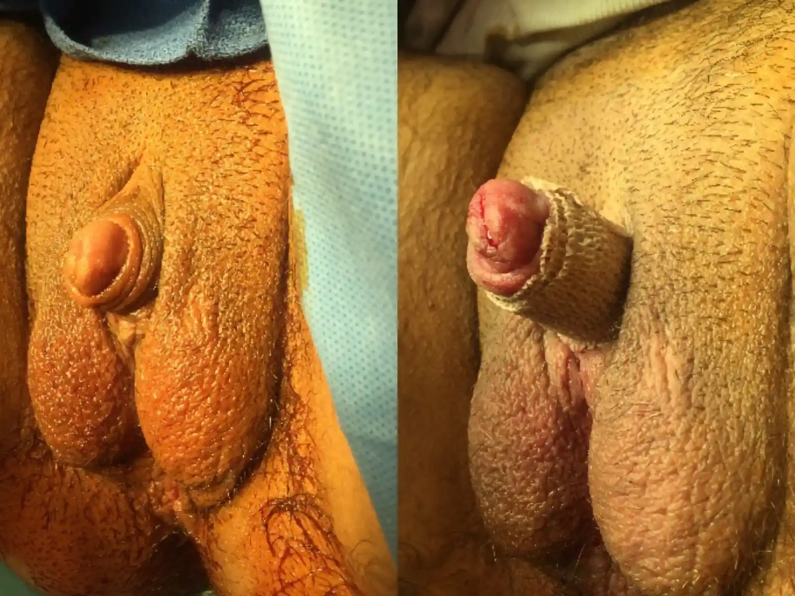 Before and after simple metoidioplasty. The goal of this operation is to change the direction of the penis to a more upward and outward position.