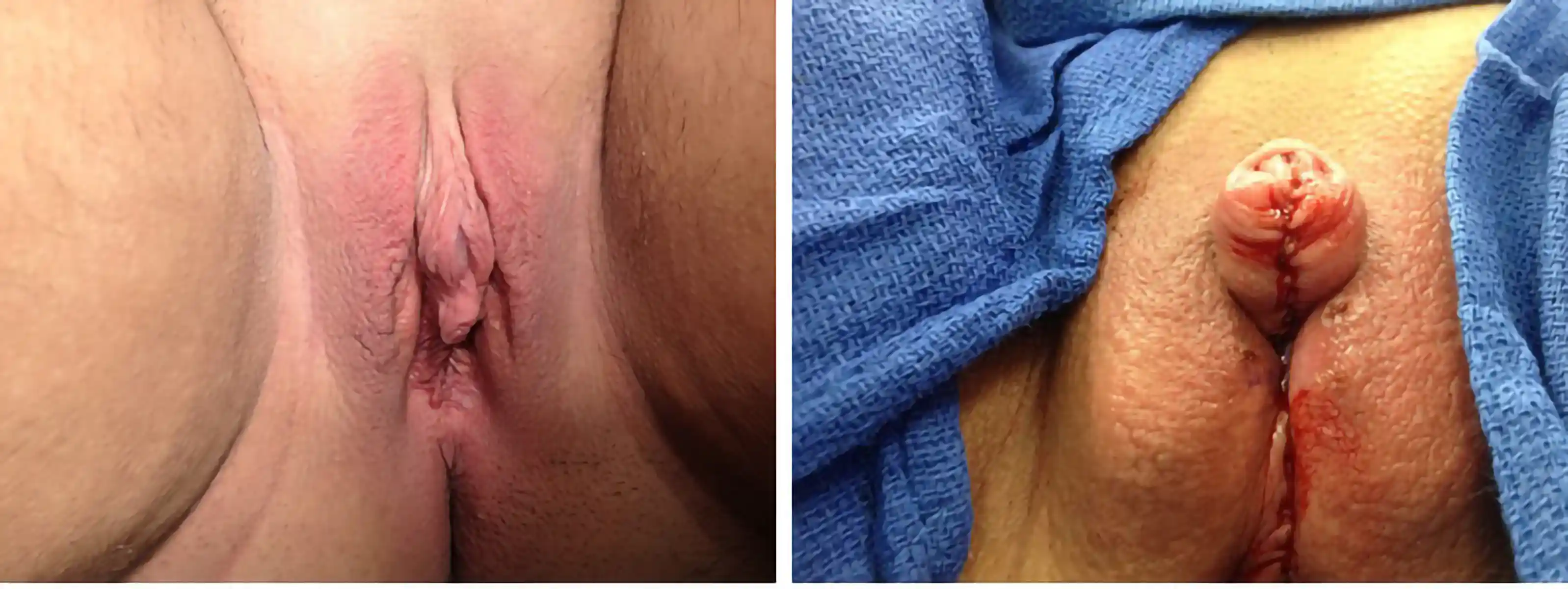 Preoperative photo before metoidioplasty. Skin is preserved whenever possible to maximize foreskin reconstruction.