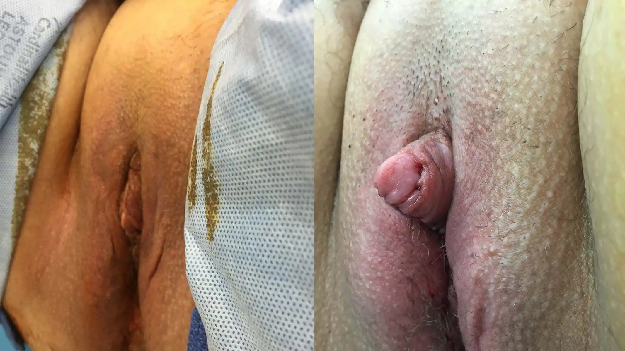 Demonstrates how simple metoidioplasty changes the direction of the penis to increase visibility.