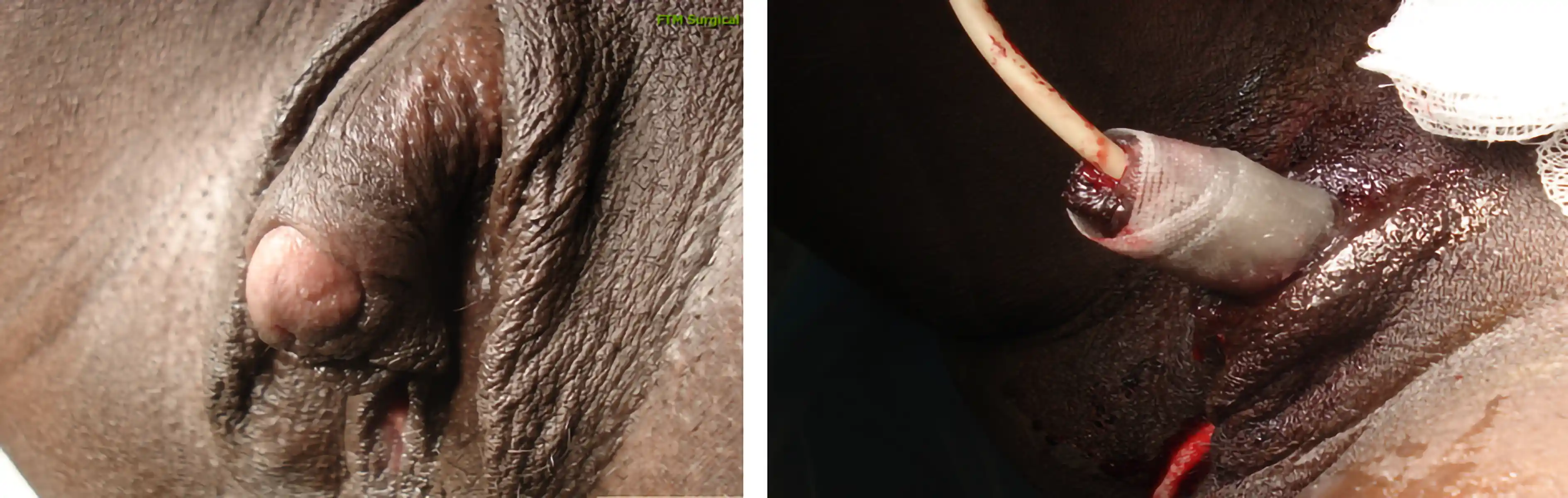 Before and after metoidioplasty with urethral lengthening. Foley catheter remains in place for one week; the suprapubic tube is removed about four weeks post-op.