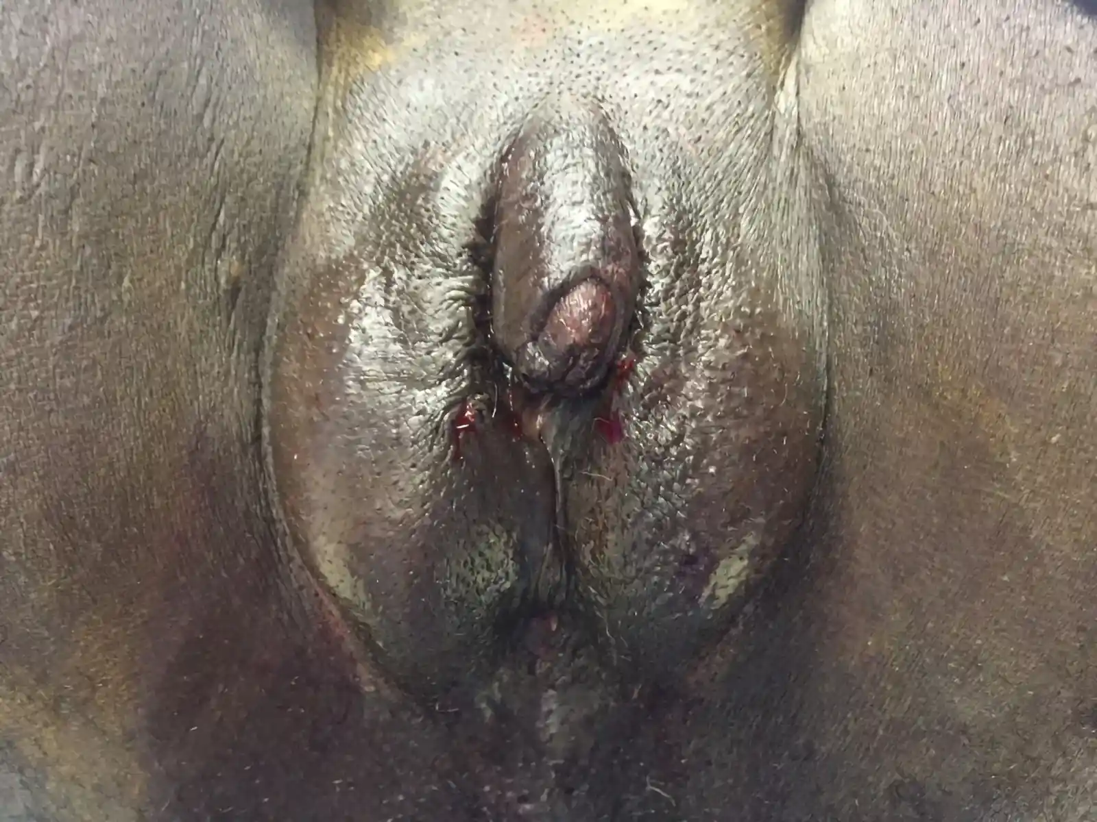 Postoperative results after metoidioplasty with urethral lengthening.