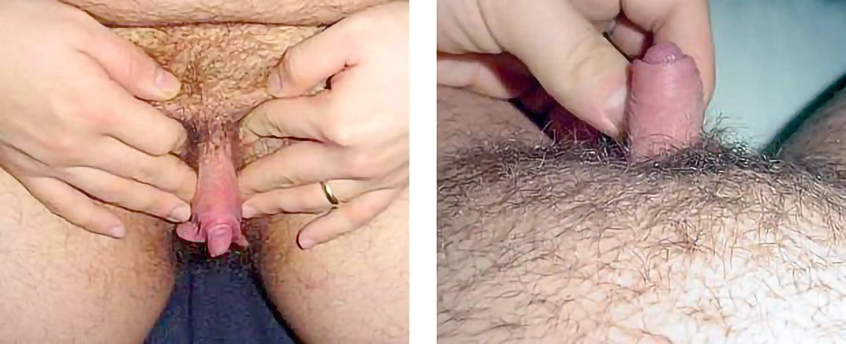 Patient with good testosterone-induced growth showing excellent metoidioplasty results.