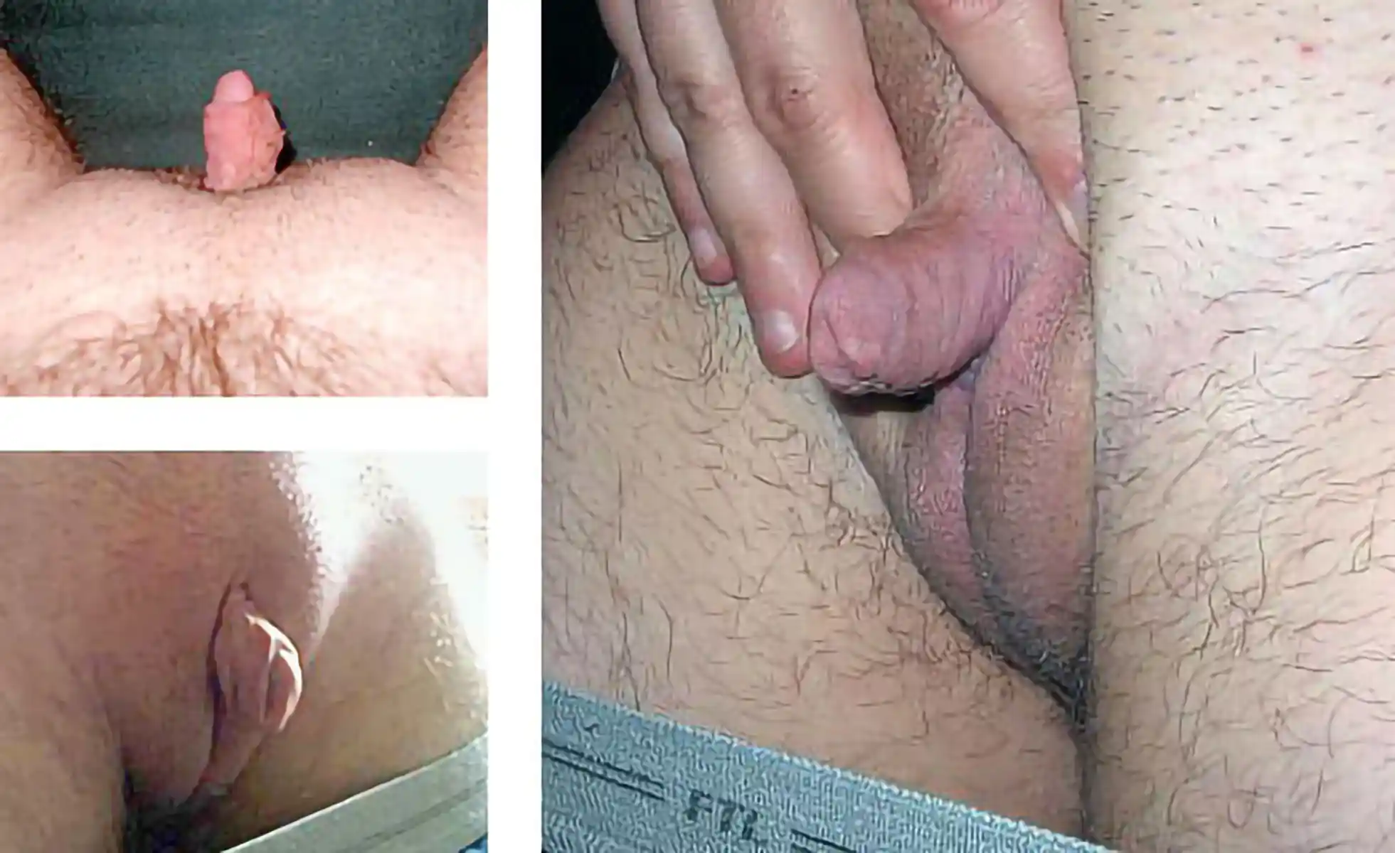 Patient-supplied photo after metoidioplasty showing penile projection months after surgery once swelling had resolved.
