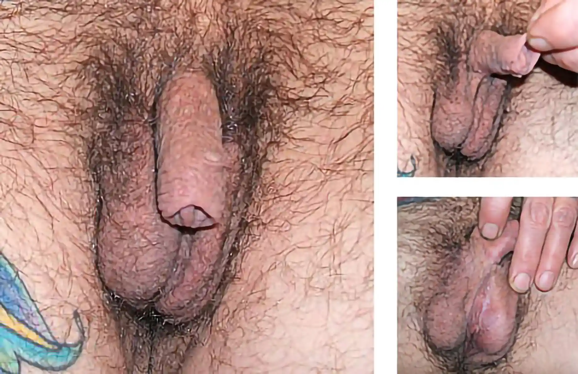 Postsurgical changes of metoidioplasty with urethral lengthening and scrotoplasty in a patient with significant testosterone growth.