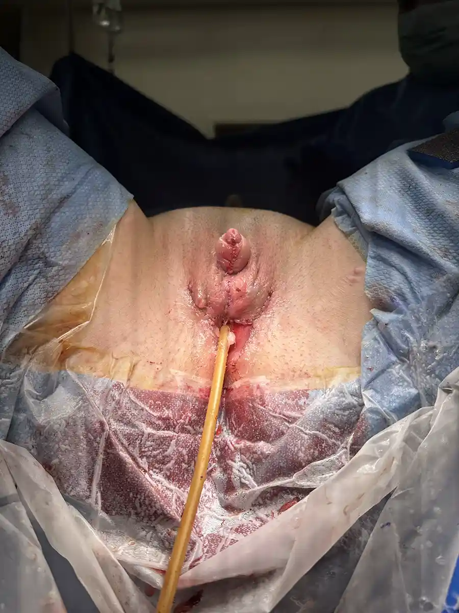 Underside view of incisions following metoidioplasty. Central scars resemble the midline raphe of cisgender males.