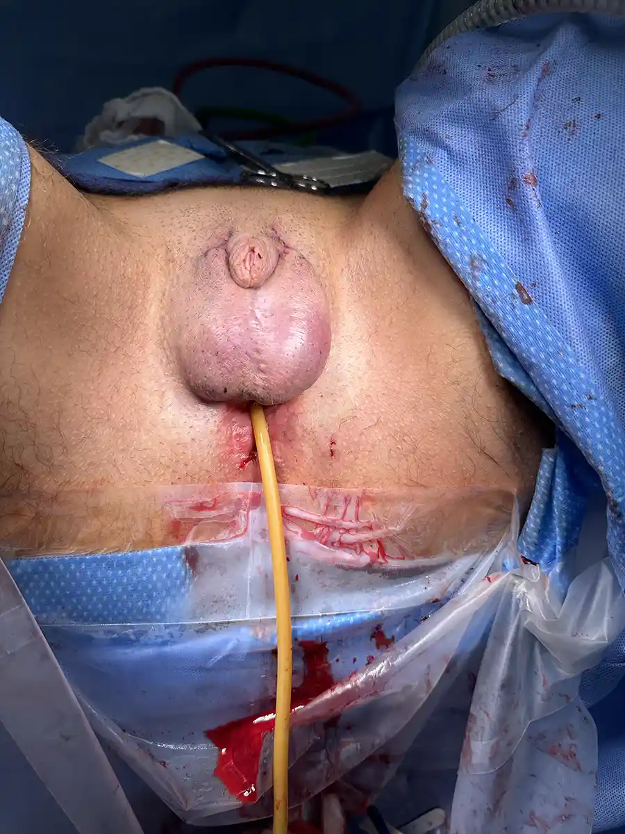 Postoperative completion of large testicular implant placement. A V-Y advancement was performed for increased projection.