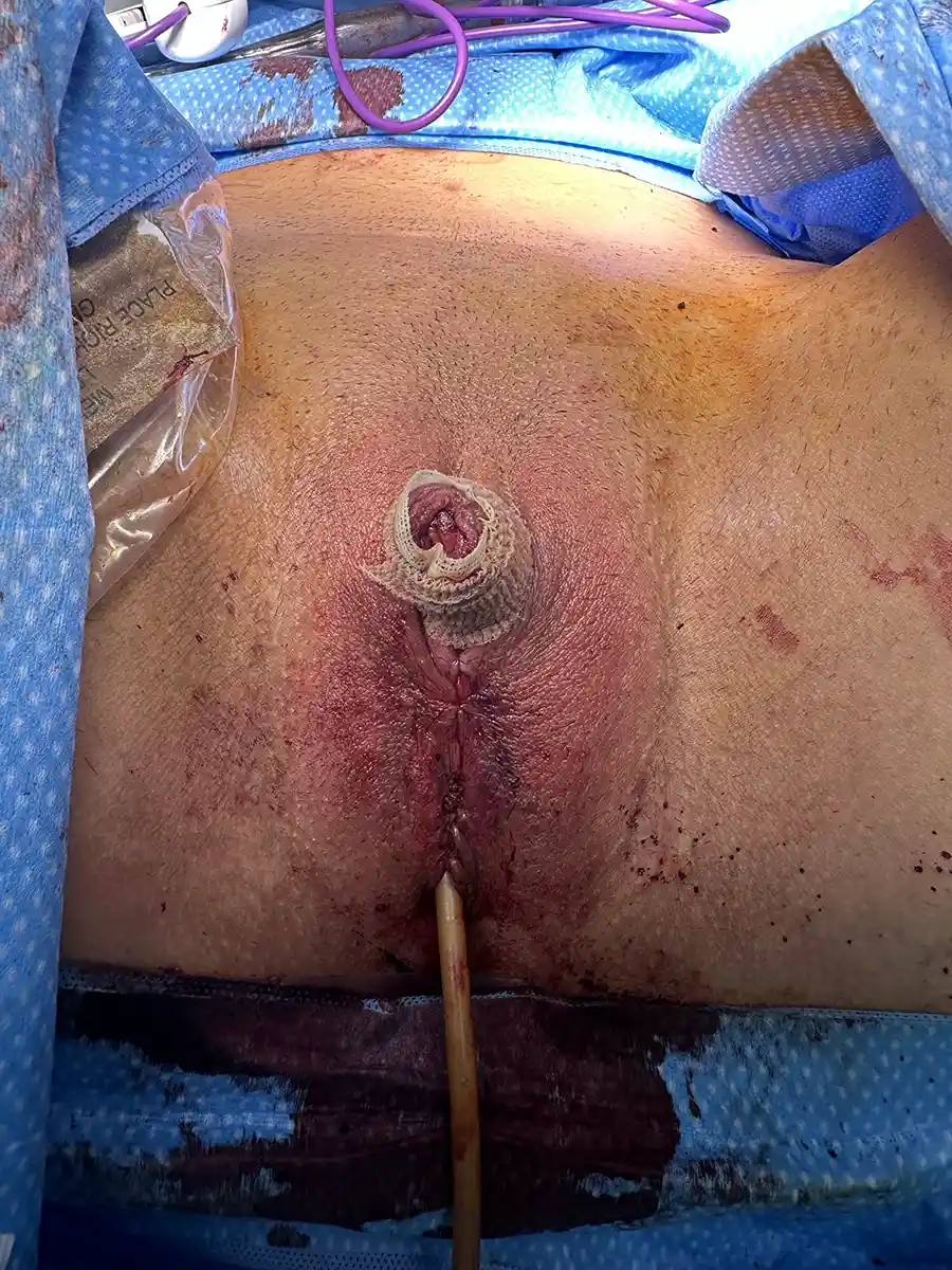 Example of simple metoidioplasty. The patient did not experience dysphoria from sitting to urinate and chose to minimize complications. Returned later for testicular implants.