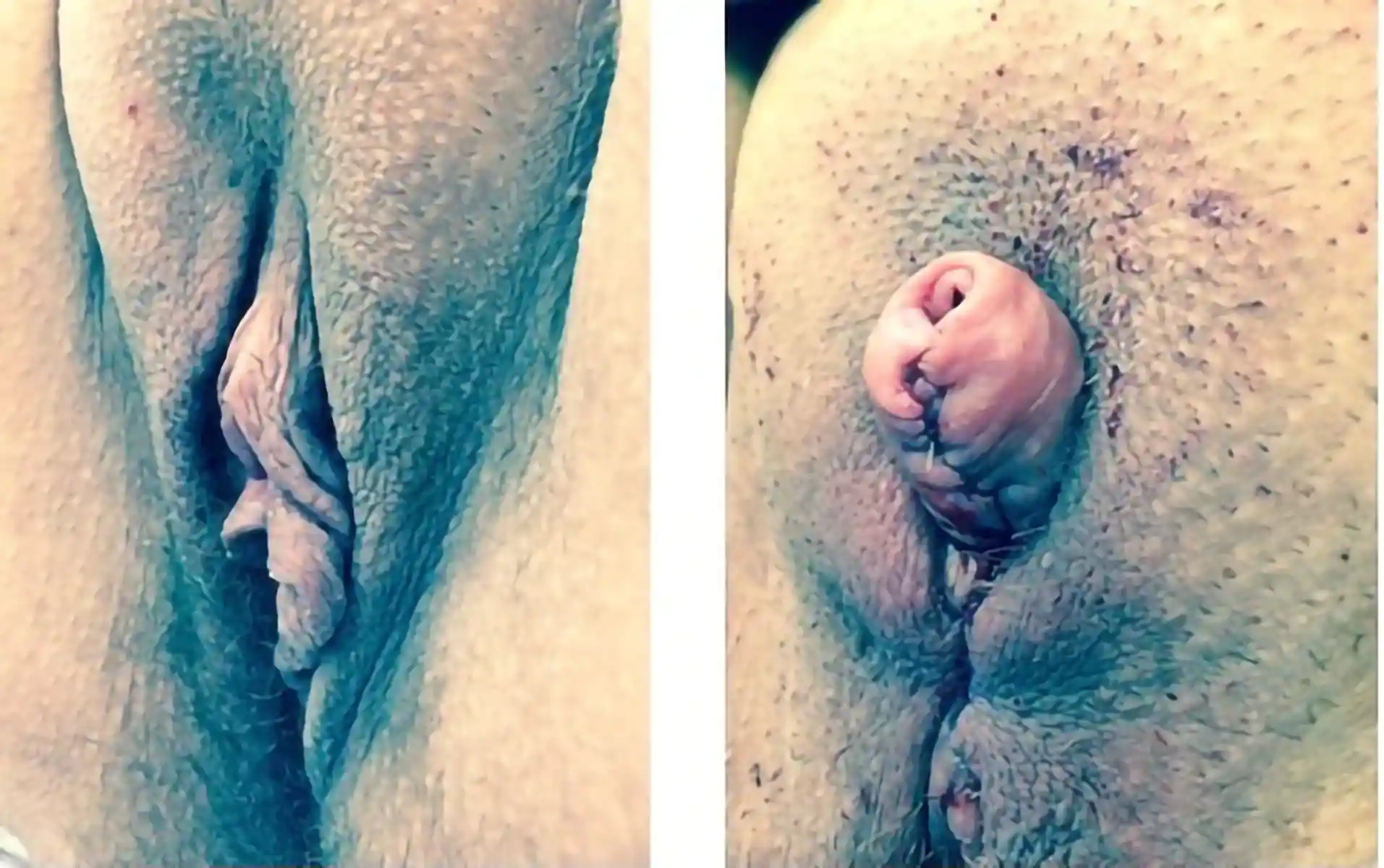 Before and after simple metoidioplasty. Sensation is maintained because nerves of the penis are preserved during the operation.