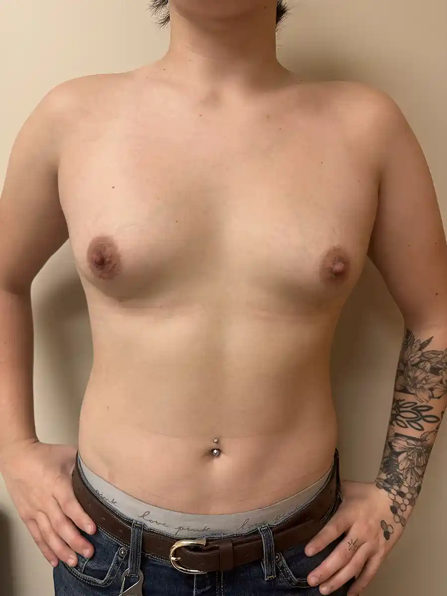Demonstrates targeted liposuction performed to enhance feminine body contours. Fat removed from the flanks and abdomen was grafted into the breasts to create natural volume and improved proportion.