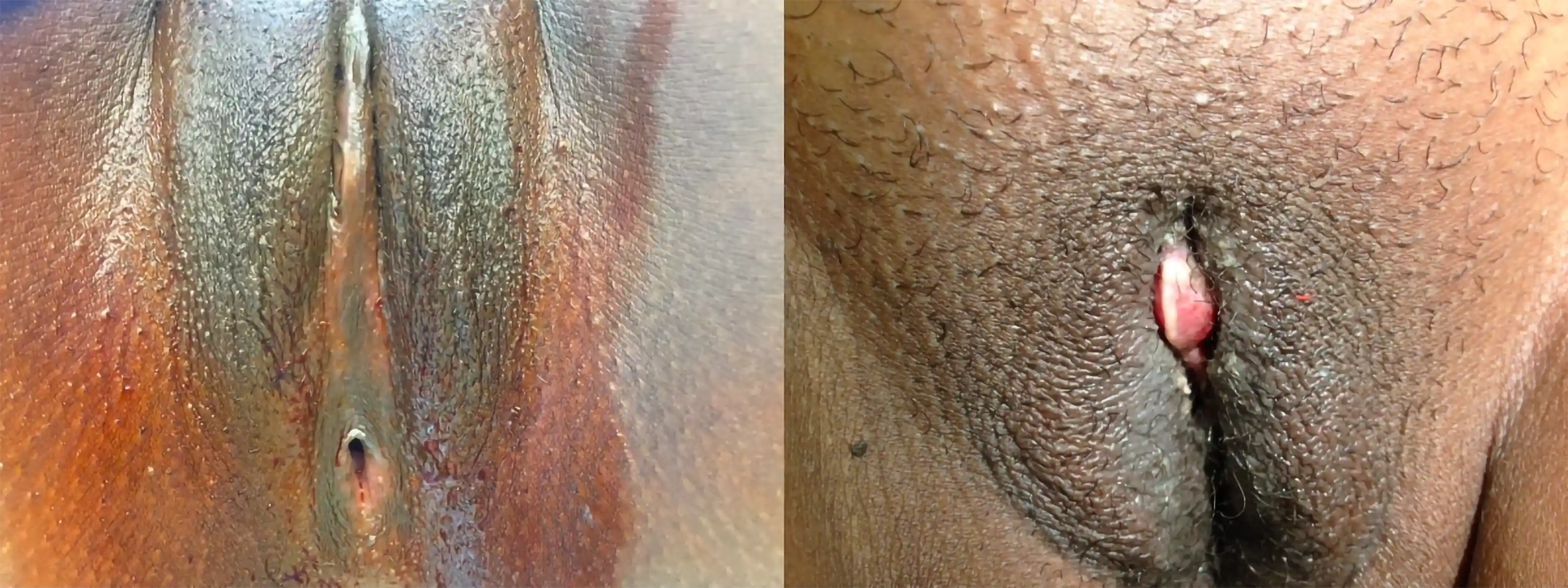 Type III FGM reconstruction performed in February 2017 showing anatomical restoration and reformation of the clitoral and labial structures.