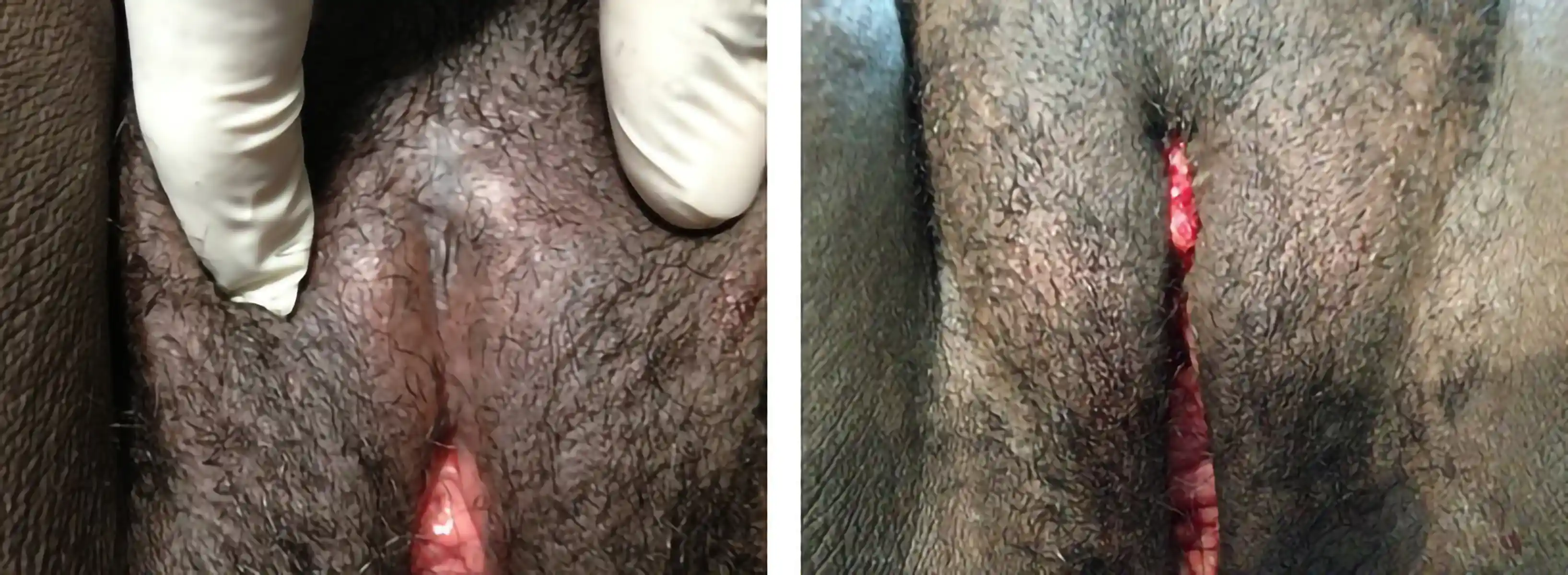 Pre- and postoperative views demonstrating restored clitoral and labial structures with good cosmetic and functional outcomes.