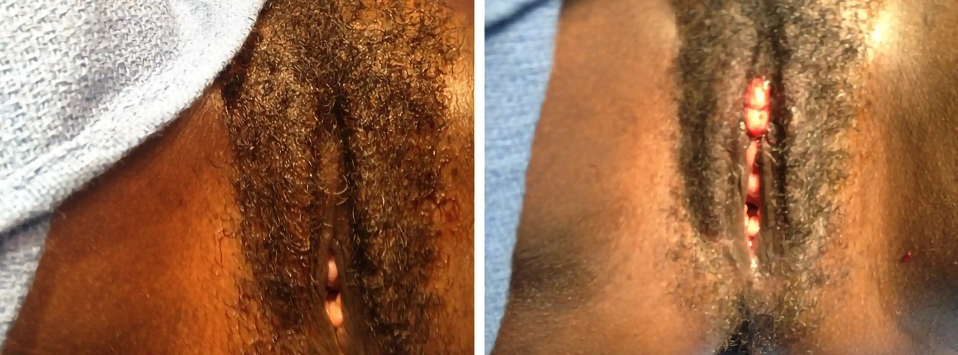 Pre- and postoperative views showing excellent tissue recovery and contour refinement following clitoral restoration surgery.